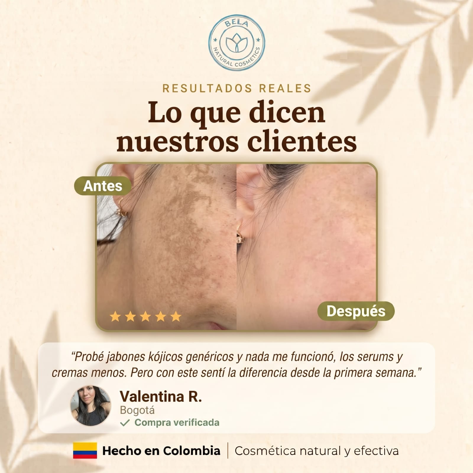 Antes y después de clienta Bela: aclaramiento de melasma en el rostro